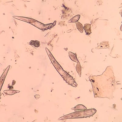 Demodex is a tiny mite that lives along the eyelid in those with heavy biofilm | Centers for dry eye