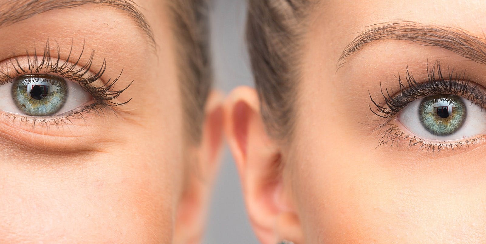 women with before and after blephEx treatment | Centers for Dry Eye